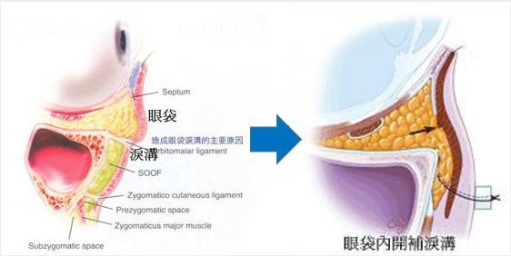 複合式眼袋內開手術 複合式眼袋內開手術
