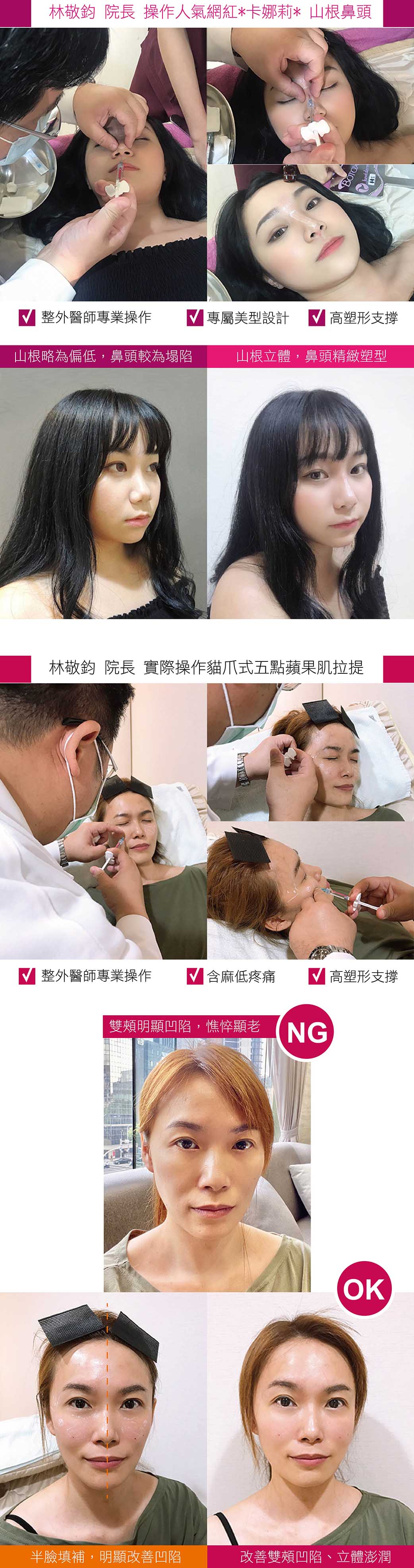 林敬鈞, 貓爪式五點拉提