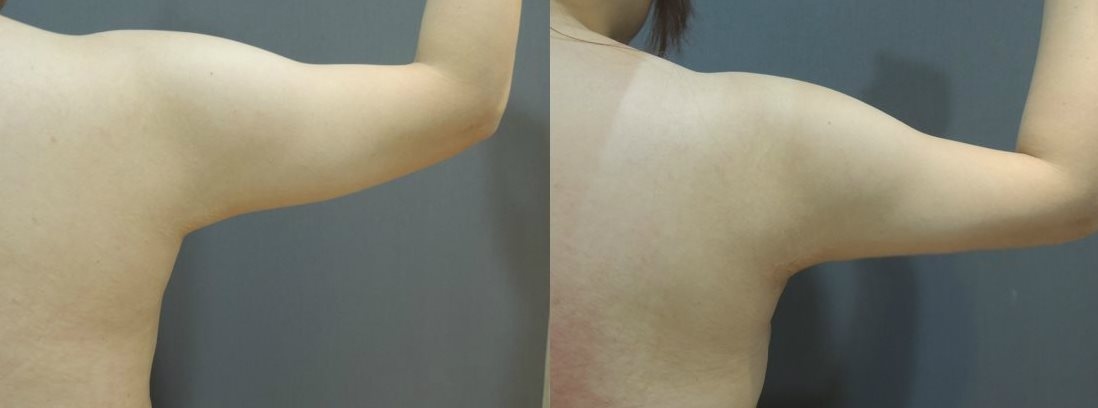 手臂抽脂, 手臂 抽脂