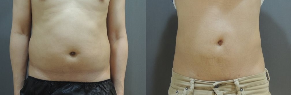 腹部 抽脂,腹部抽脂  男性 