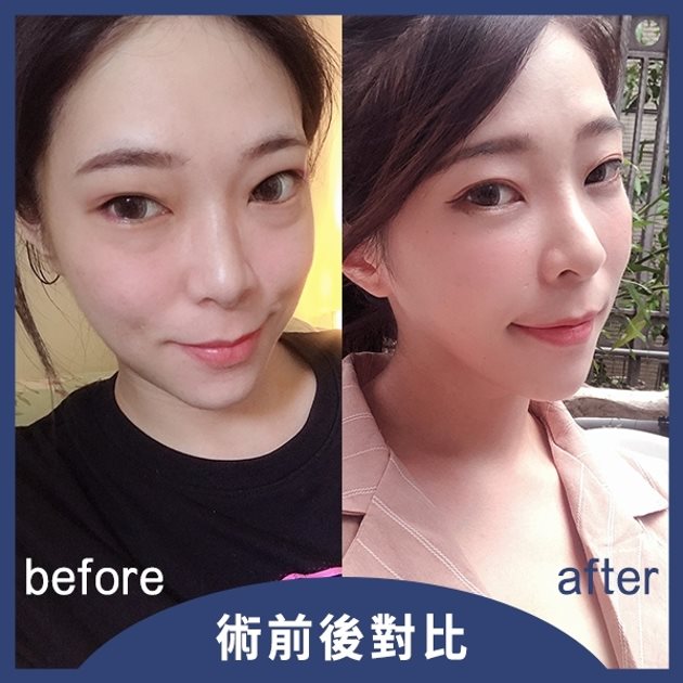 複合式眼袋內開, 抽眼袋 複合式眼袋內開, 抽眼袋