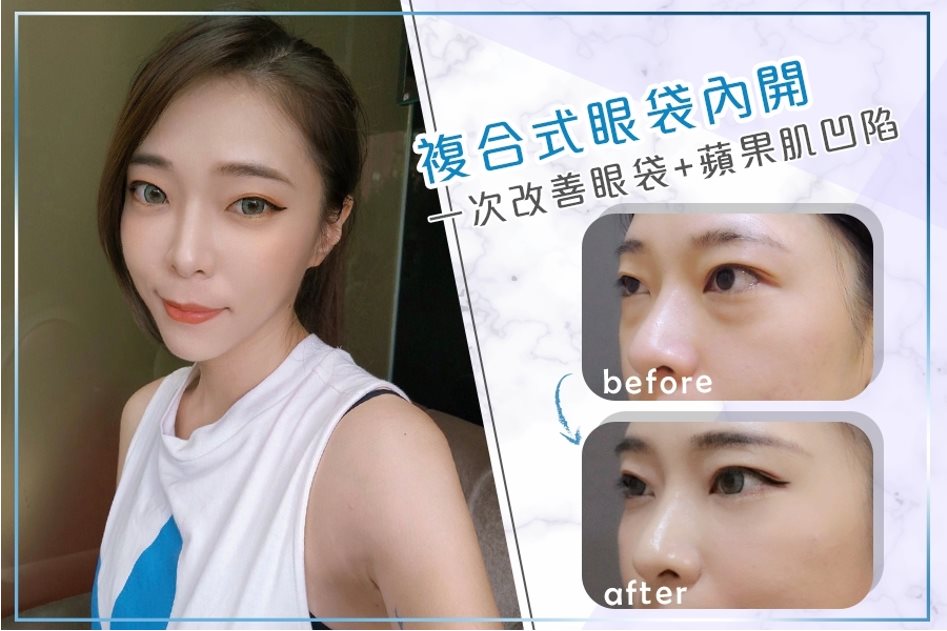 複合式眼袋內開 成功案例分享 複合式眼袋內開 成功案例分享