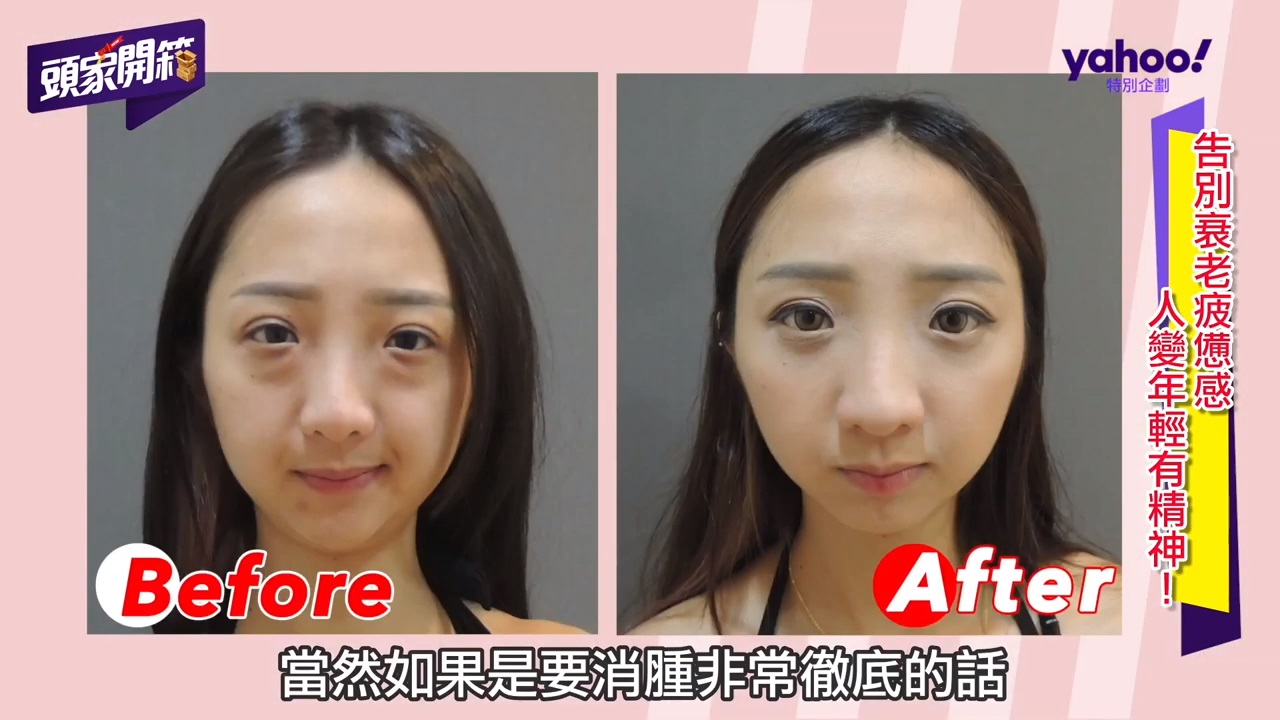 複合式眼袋內開手術 複合式眼袋內開手術