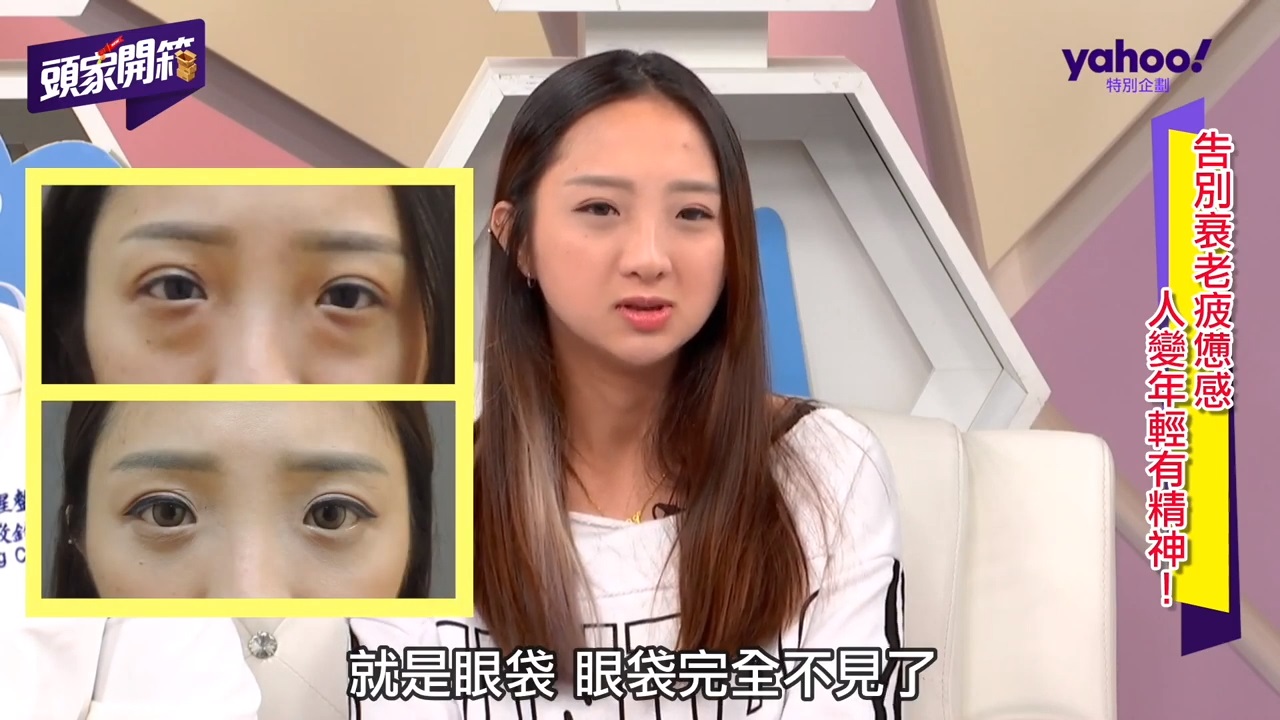 複合式 眼袋內開 複合式 眼袋內開
