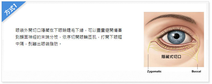 眼袋,眼袋手術,台北眼袋,眼袋手術醫生-林敬鈞院長
