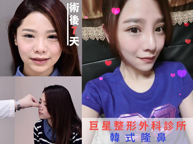 三段式隆鼻, 韓式隆鼻 三段式隆鼻, 韓式隆鼻