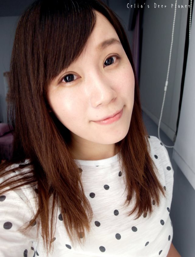雙眼皮術後