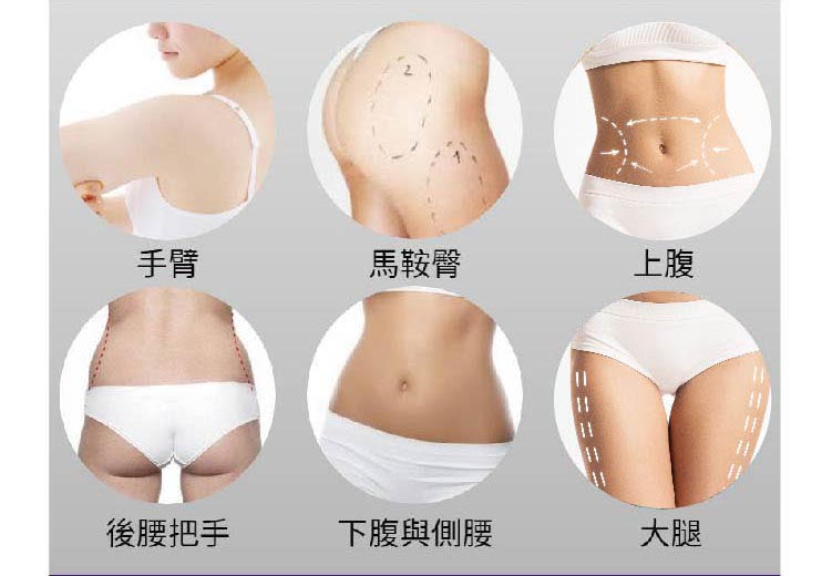 適合自體脂肪隆乳的抽脂部位