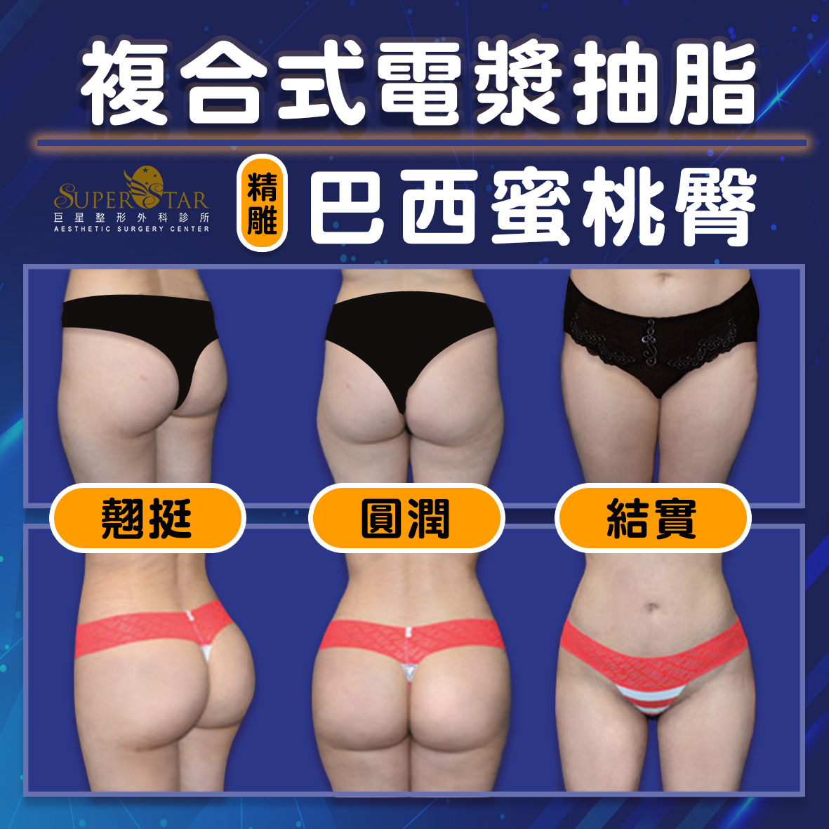 自體脂肪豐臀