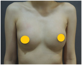 二次隆乳,隆乳重修,隆乳修復, 隆乳手術,隆乳,林敬鈞,林敬鈞隆乳