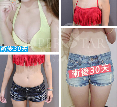 隆乳案例,隆乳哺乳,自體脂肪隆乳,自體脂肪豐胸,隆乳抽脂林敬鈞醫師