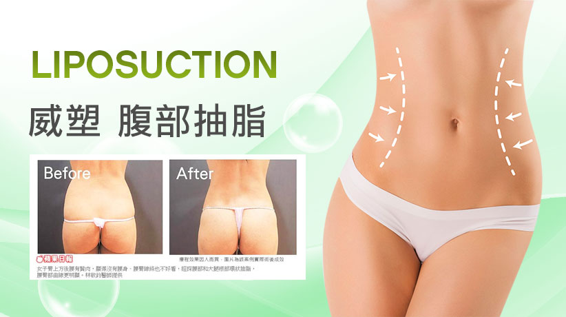 腹部抽脂