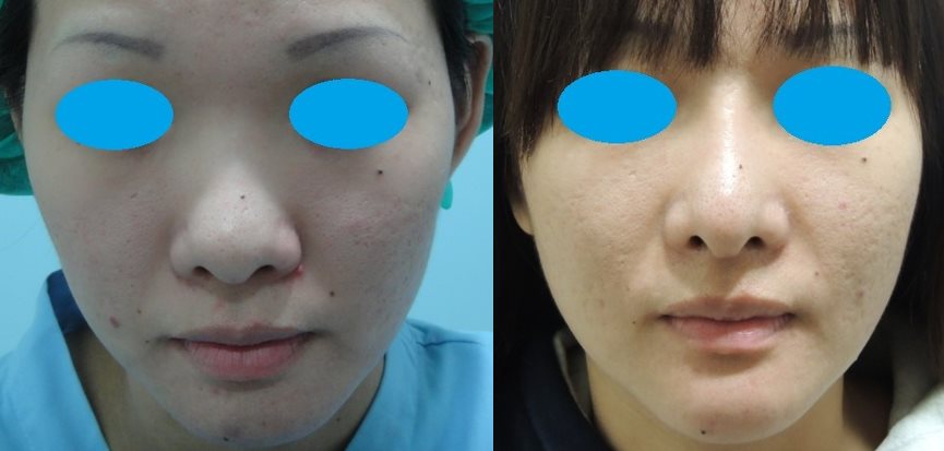 自體肋骨隆鼻